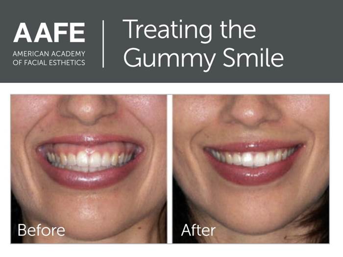 Gummy Smile Before & After